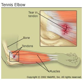 Tennis Elbow